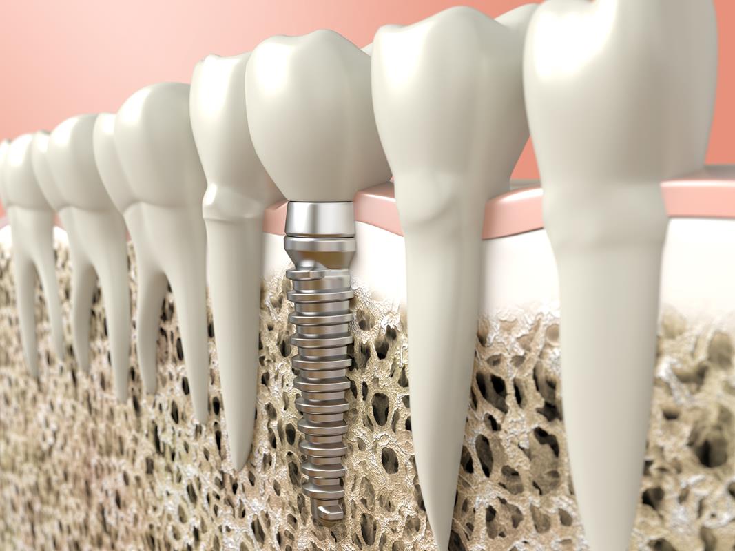 Dental Implants  Somerville, MA 